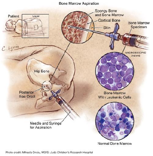 Pre B Cell Acute Lymphoblastic Leukemia In Adults Pre B Cell Acute Lymphoblastic Leukemia In Adults